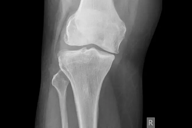 Punca Sakit lutut Warga Emas