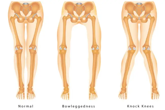 Sakit Lutut Posture Salah